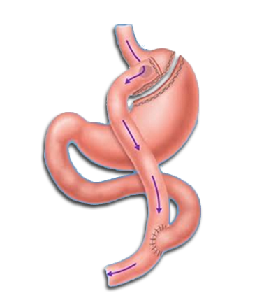 bypass gastrico